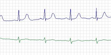 Electrocardiogram for MIT-BIH ECG Compression Test, record 13585_01