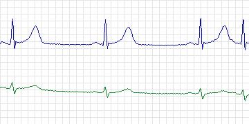 Electrocardiogram for MIT-BIH ECG Compression Test, record 13585_02