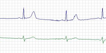 Electrocardiogram for MIT-BIH ECG Compression Test, record 13585_03