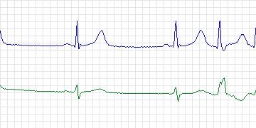 Electrocardiogram for MIT-BIH ECG Compression Test, record 13585_04