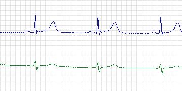 Electrocardiogram for MIT-BIH ECG Compression Test, record 13585_05