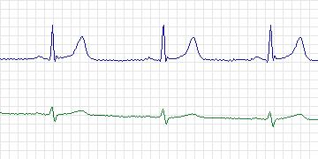 Electrocardiogram for MIT-BIH ECG Compression Test, record 13585_08