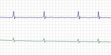 Electrocardiogram for MIT-BIH ECG Compression Test, record 13649_01