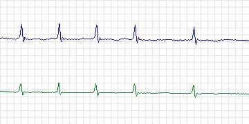 Electrocardiogram for MIT-BIH ECG Compression Test, record 13649_02