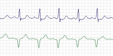 Electrocardiogram for MIT-BIH ECG Compression Test, record 13687_01