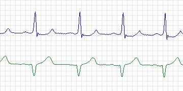 Electrocardiogram for MIT-BIH ECG Compression Test, record 13687_02