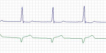 Electrocardiogram for MIT-BIH ECG Compression Test, record 13687_03