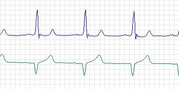 Electrocardiogram for MIT-BIH ECG Compression Test, record 13687_04
