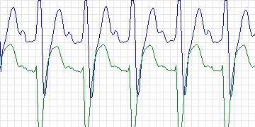 Electrocardiogram for BIDMC Congestive Heart Failure, record chf11