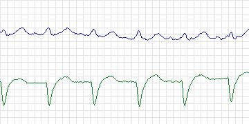 Electrocardiogram for BIDMC Congestive Heart Failure, record chf12