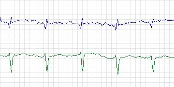 Electrocardiogram for BIDMC Congestive Heart Failure, record chf13