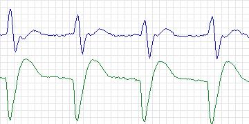 Electrocardiogram for BIDMC Congestive Heart Failure, record chf14