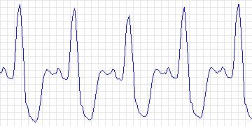 Electrocardiogram for Creighton University Ventricular Tachyarrhythmia, record cu11