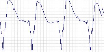 Electrocardiogram for Creighton University Ventricular Tachyarrhythmia, record cu12
