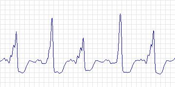 Electrocardiogram for Creighton University Ventricular Tachyarrhythmia, record cu13