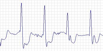Electrocardiogram for Creighton University Ventricular Tachyarrhythmia, record cu14