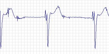 Electrocardiogram for Creighton University Ventricular Tachyarrhythmia, record cu15
