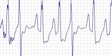 Electrocardiogram for Creighton University Ventricular Tachyarrhythmia, record cu16