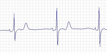 Electrocardiogram for Creighton University Ventricular Tachyarrhythmia, record cu17