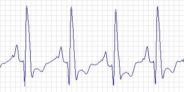 Electrocardiogram for Creighton University Ventricular Tachyarrhythmia, record cu18