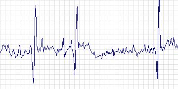 Electrocardiogram for Creighton University Ventricular Tachyarrhythmia, record cu20