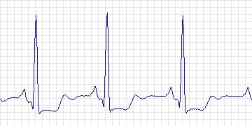 Electrocardiogram for Creighton University Ventricular Tachyarrhythmia, record cu22