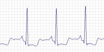 Electrocardiogram for Creighton University Ventricular Tachyarrhythmia, record cu23