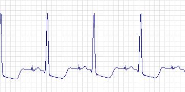 Electrocardiogram for Creighton University Ventricular Tachyarrhythmia, record cu24