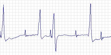 Electrocardiogram for Creighton University Ventricular Tachyarrhythmia, record cu25