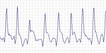 Electrocardiogram for Creighton University Ventricular Tachyarrhythmia, record cu26