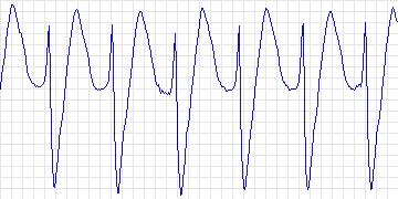 Electrocardiogram for Creighton University Ventricular Tachyarrhythmia, record cu28