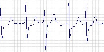 Electrocardiogram for Creighton University Ventricular Tachyarrhythmia, record cu29