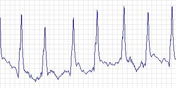 Electrocardiogram for Creighton University Ventricular Tachyarrhythmia, record cu30