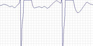 Electrocardiogram for Creighton University Ventricular Tachyarrhythmia, record cu31
