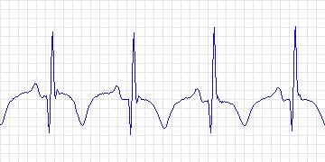 Electrocardiogram for Creighton University Ventricular Tachyarrhythmia, record cu33