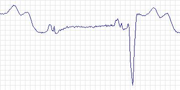 Electrocardiogram for Creighton University Ventricular Tachyarrhythmia, record cu34
