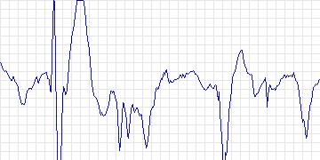 Electrocardiogram for Creighton University Ventricular Tachyarrhythmia, record cu35