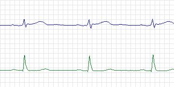 Electrocardiogram for European ST-T, record e0105