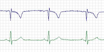 Electrocardiogram for European ST-T, record e0107