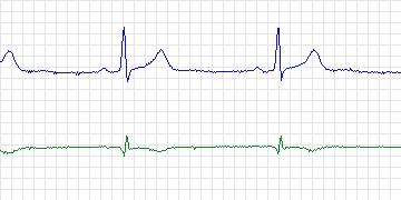 Electrocardiogram for European ST-T, record e0108