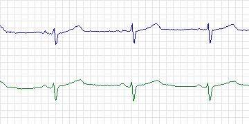 Electrocardiogram for European ST-T, record e0110