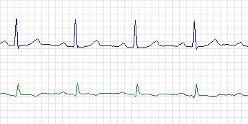 Electrocardiogram for European ST-T, record e0122