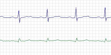 Electrocardiogram for European ST-T, record e0123