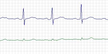 Electrocardiogram for European ST-T, record e0124