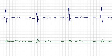 Electrocardiogram for European ST-T, record e0125