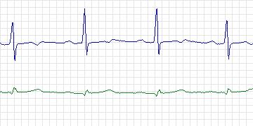 Electrocardiogram for European ST-T, record e0126