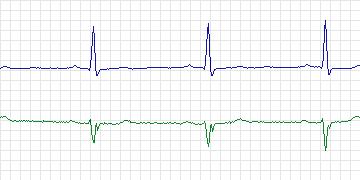 Electrocardiogram for European ST-T, record e0127