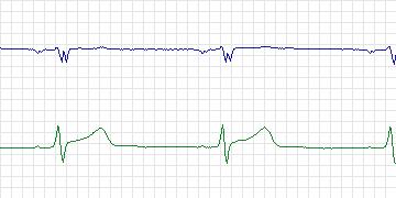 Electrocardiogram for European ST-T, record e0129