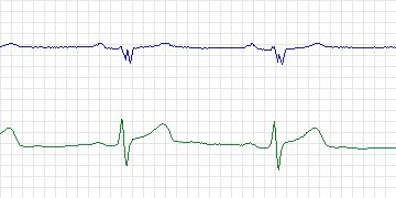 Electrocardiogram for European ST-T, record e0133