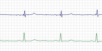 Electrocardiogram for European ST-T, record e0136